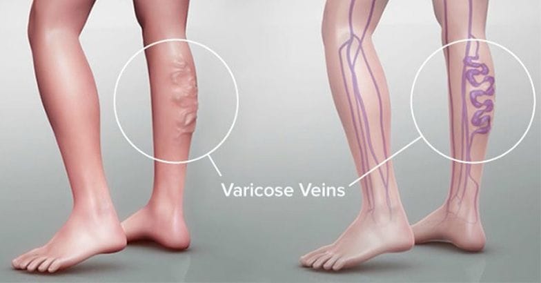 cele mai bune instrumente din revizuirile picioarelor varicose prevenirea venelor vene dupa natere