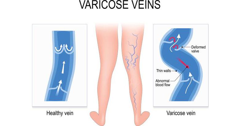 venous stasis treatment medication vatul varicose