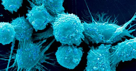 prostate-cancer-cells