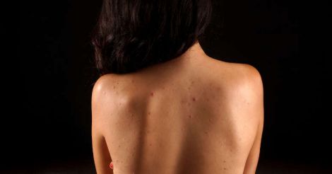 back-acne