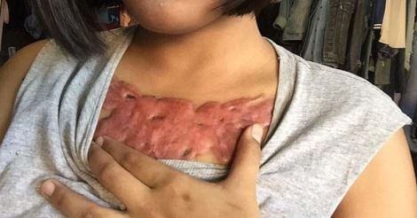 Teen tries to remove tattoo using a tattoo remover cream