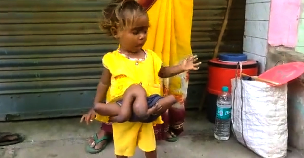 Baby girl born with four arms and legs Actor with medical help