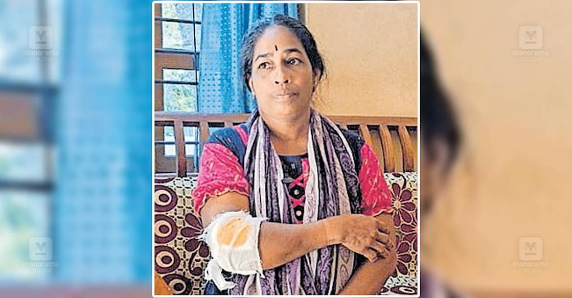 വളർത്തു നായയുടെ കടിയേറ്റ് ഷൈമ സുഭാഷ്.  
