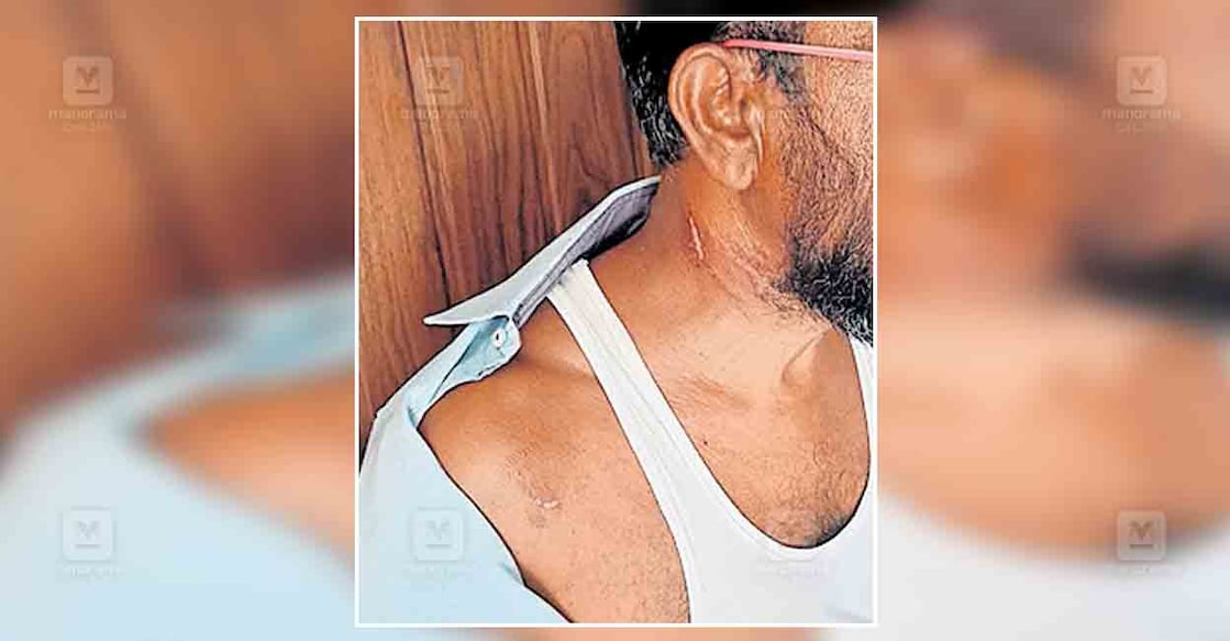 കൊച്ചുണ്ണിയുടെ കഴുത്തിലും നെഞ്ചിലും സൂര്യാതപമേറ്റ നിലയിൽ.  