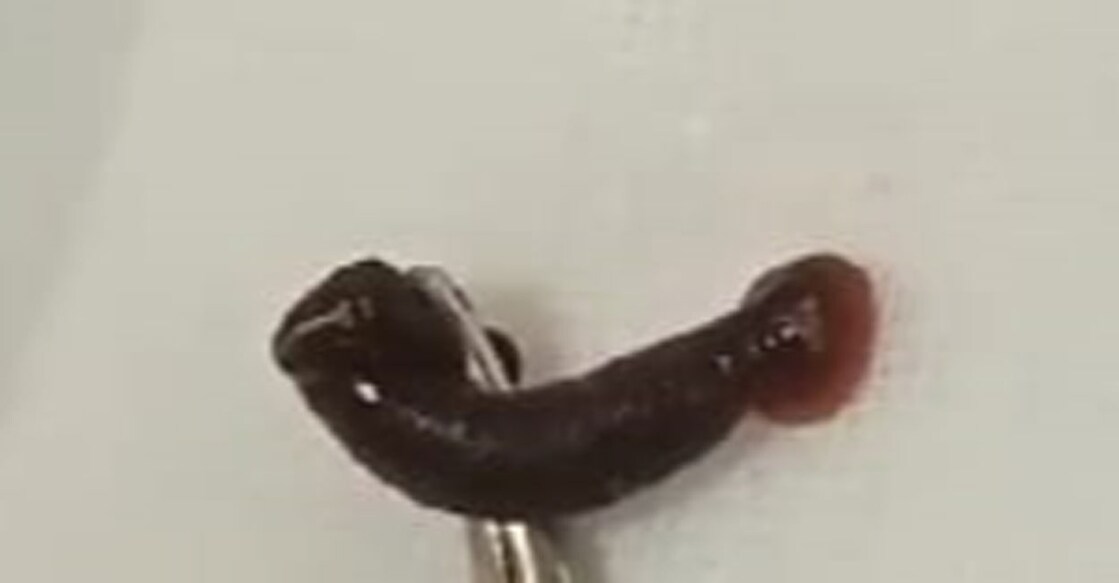 മൂക്കിൽ നിന്നു പുറത്തെടുത്ത ജീവി