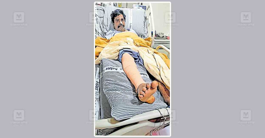 drainage-accident മൂടിയില്ലാത്ത ഓടയിൽ വീണ് കാലൊടിഞ്ഞ് ശസ്ത്രക്രിയ കഴിഞ്ഞ ജയചന്ദ്രബാബു.