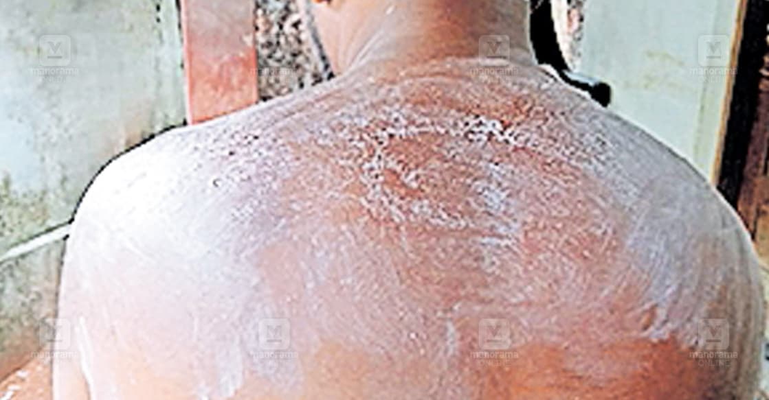 ആനക്കര കൊരട്ടിപ്പറമ്പിൽ വിനേഷിന്റെ പുറത്ത് സൂര്യാതപമേറ്റ് പൊള്ളലുണ്ടായപ്പോൾ.  
