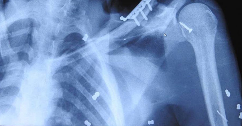 Indonesian rescuers manage to save mother orangutan hit by dozens of air rifle pellets Indonesian rescuers manage to save mother orangutan hit by dozens of air rifle pellets