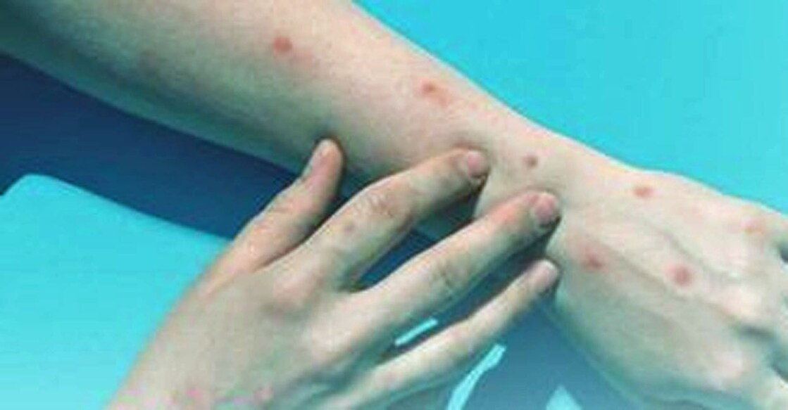 monkey-pox Image Credit:X/ Saudi Public Health Authority