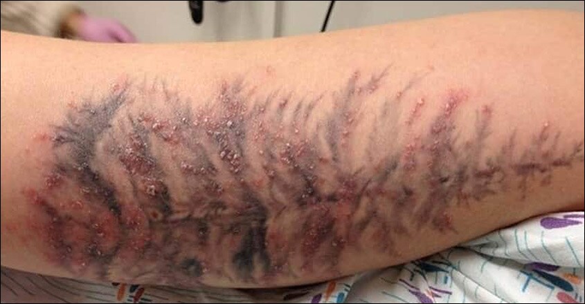 tattoo-rash tattoo-rash