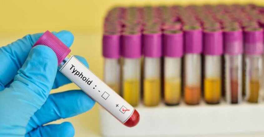 Typhoid Typhoid