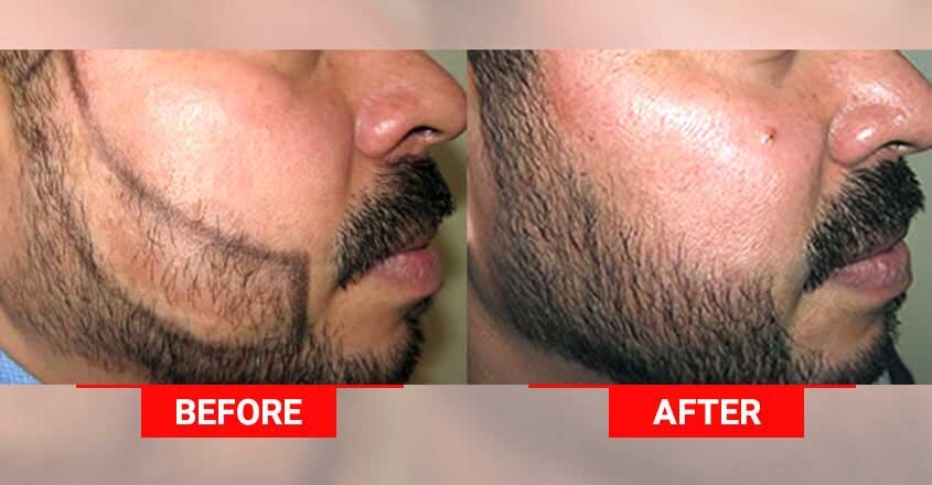 medlonges-beard-transplant-photo-procedure medlonges-beard-transplant-photo-procedure