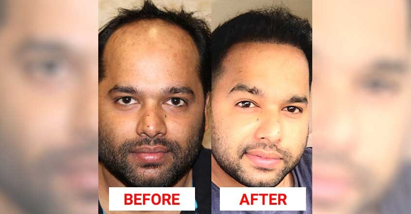 medlonges-hair-transplant-photo-procedure medlonges-hair-transplant-photo-procedure