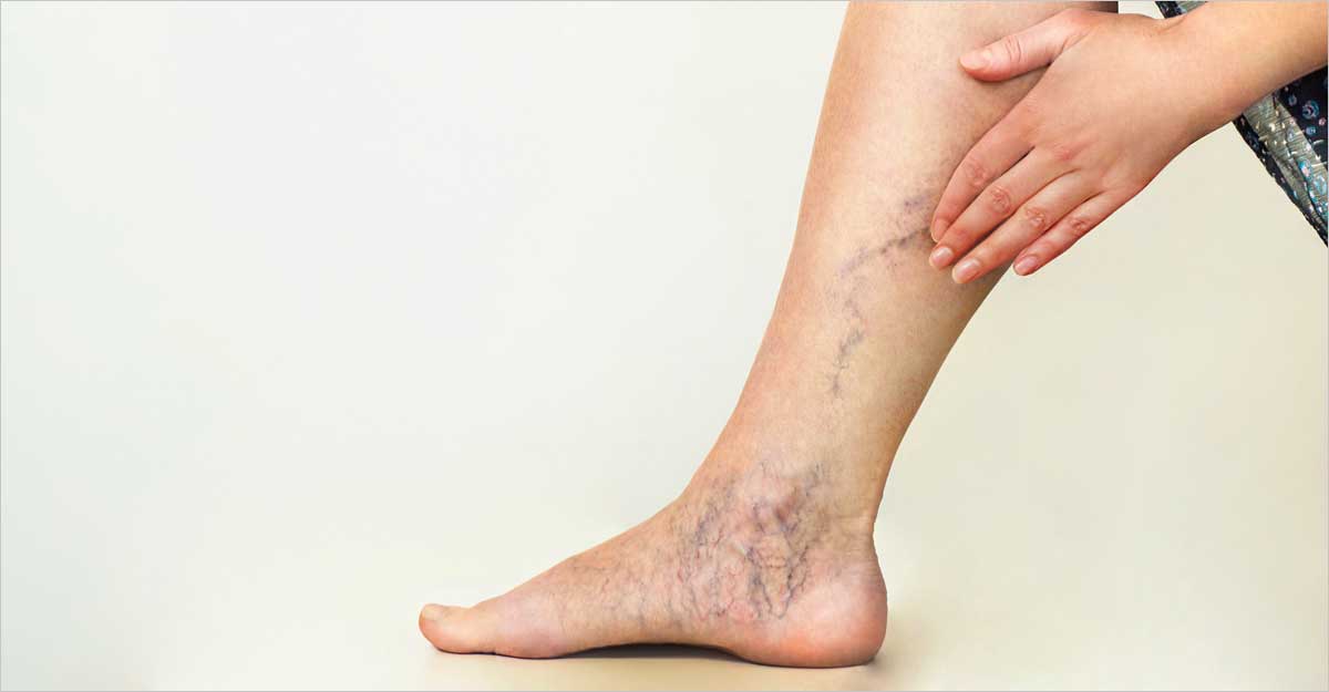 വെരിക്കോസ് വെയ്ൻ ചികിത്സിച്ചു മാറ്റാം \ Varicose vein | Varicose vein