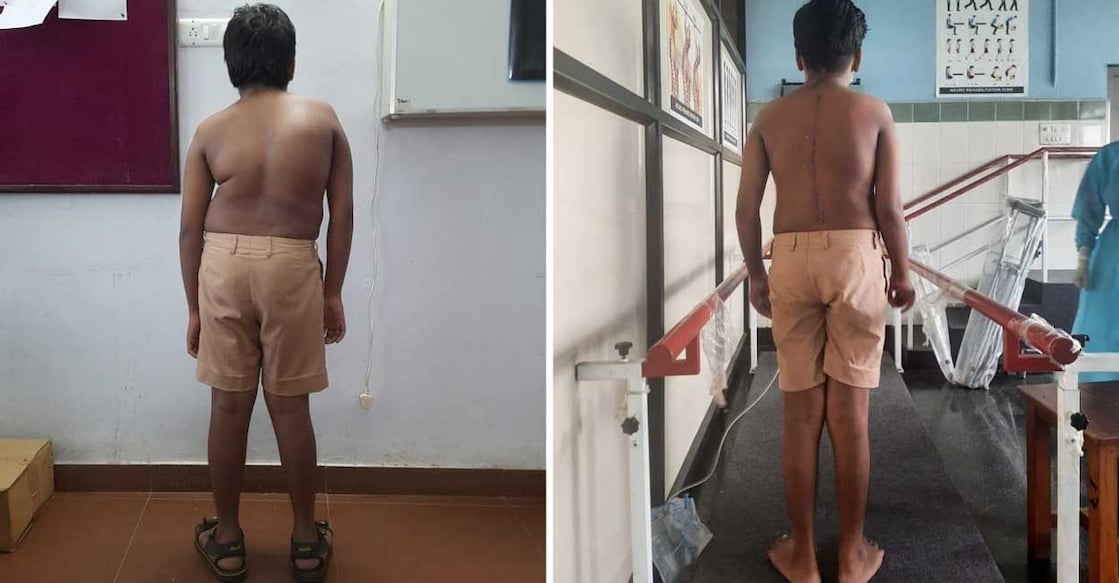 scoliosis