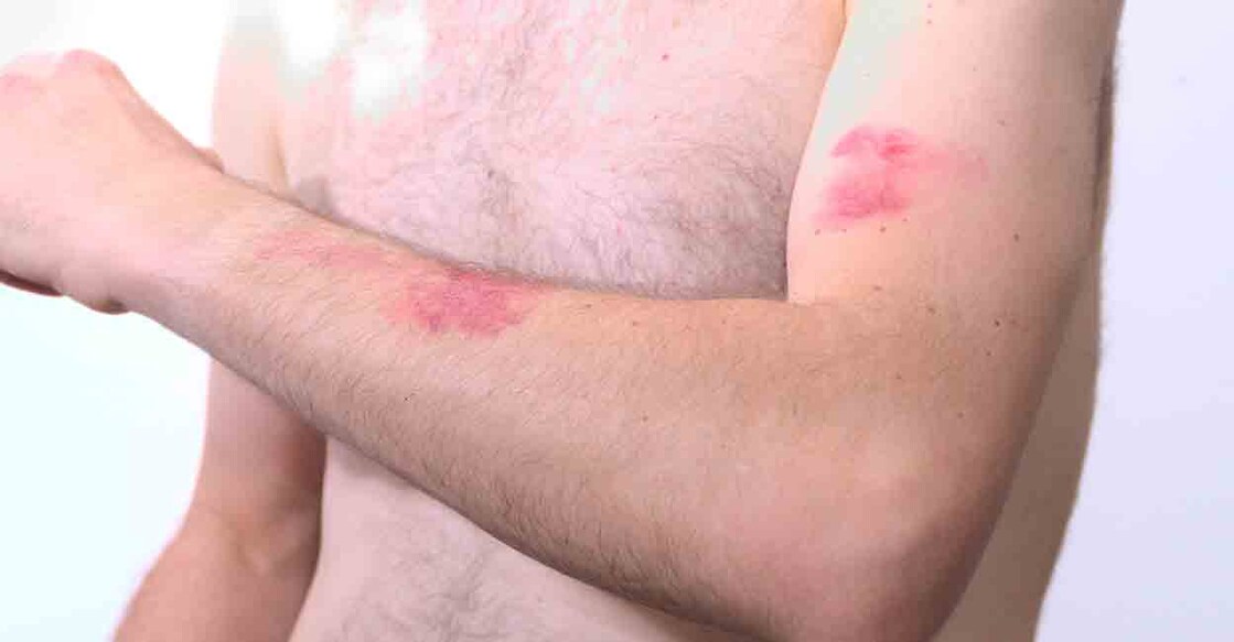 monkey pox Photo Credit : Paco Burgada/ Shutterstock.com