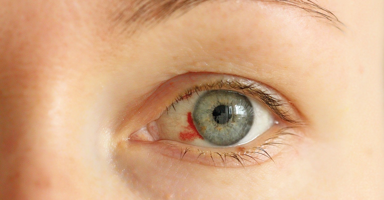 Deadly eye bleeding virus in Europe Eye bleeding Archyde