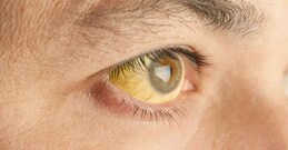 മഞ്ഞപ്പിത്തം മുതിര്‍ന്നവരില്‍ ഗുരുതരമാകാന്‍ സാധ്യതയേറെ, ശ്രദ്ധ വേണം