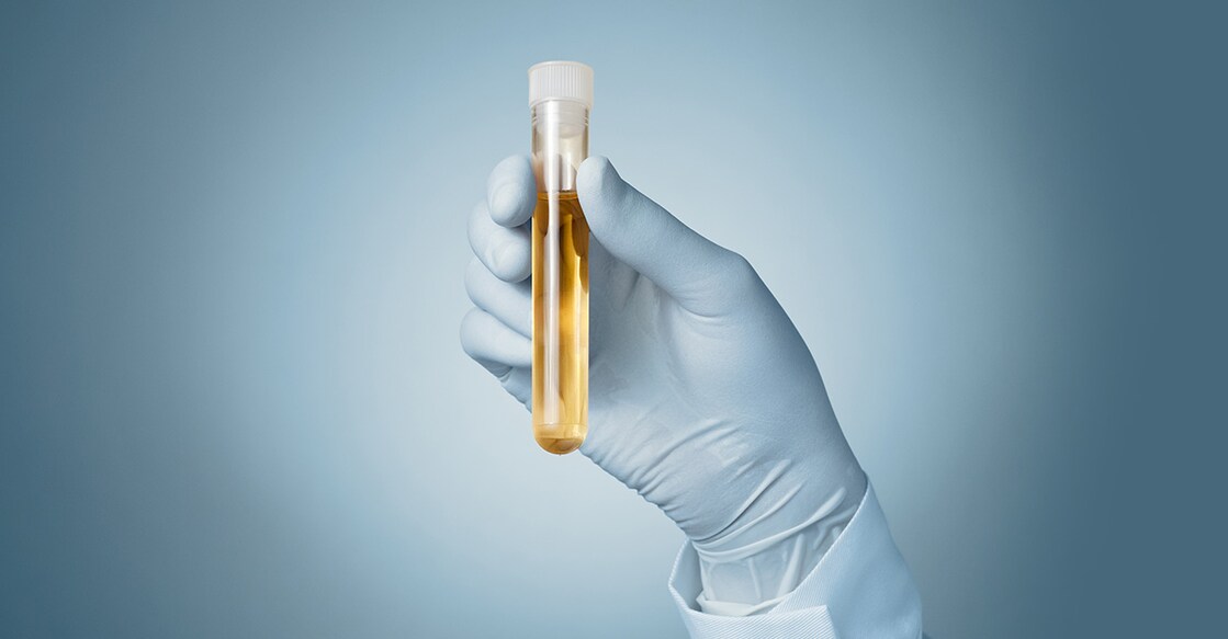 urine-test-Vonschonertagen-istockphoto