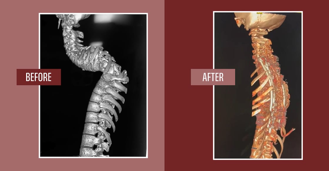 spinal-deformity-correction-surgery-success spinal-deformity-correction-surgery-success