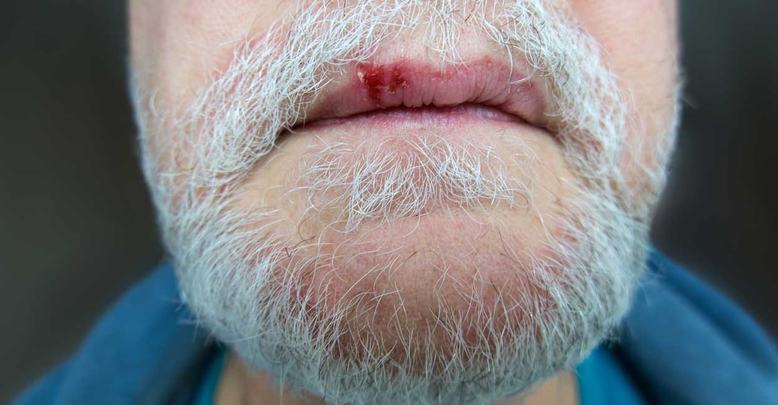 lip-cancer-Tatiana-Sidorova-istockphoto Representative image. Photo Credit: Tatiana Sidorova/istockphoto.com