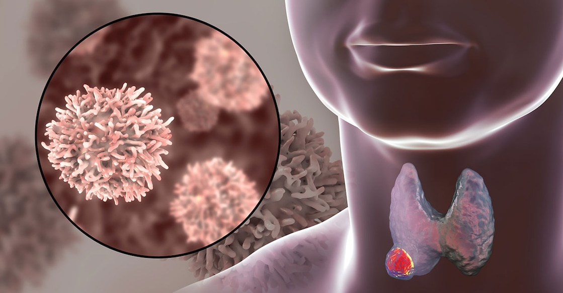 thyroid cancer Photo Credit: Dr_Microbe/ Istockphoto