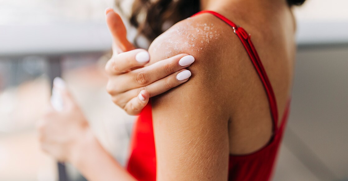 Dry Skin Problems and Sun Burn Representative Image. Photo Credit : Eleganza / iStockPhoto.com