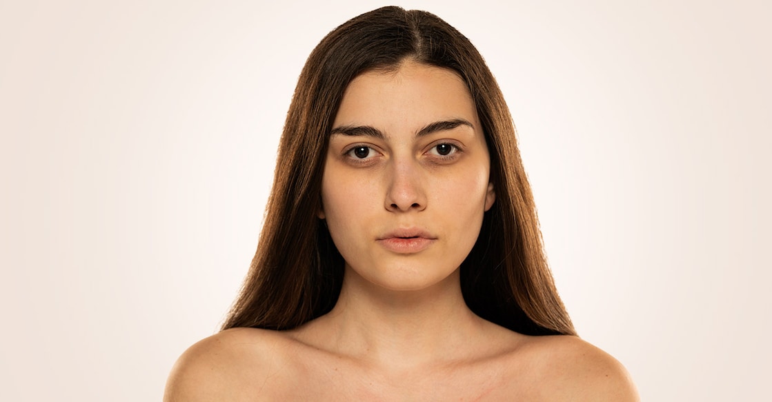 dark-under-eye-vladimirfloyd-istockphoto Representative image. Photo Credit: VladimirFLoyd/istockphoto.com