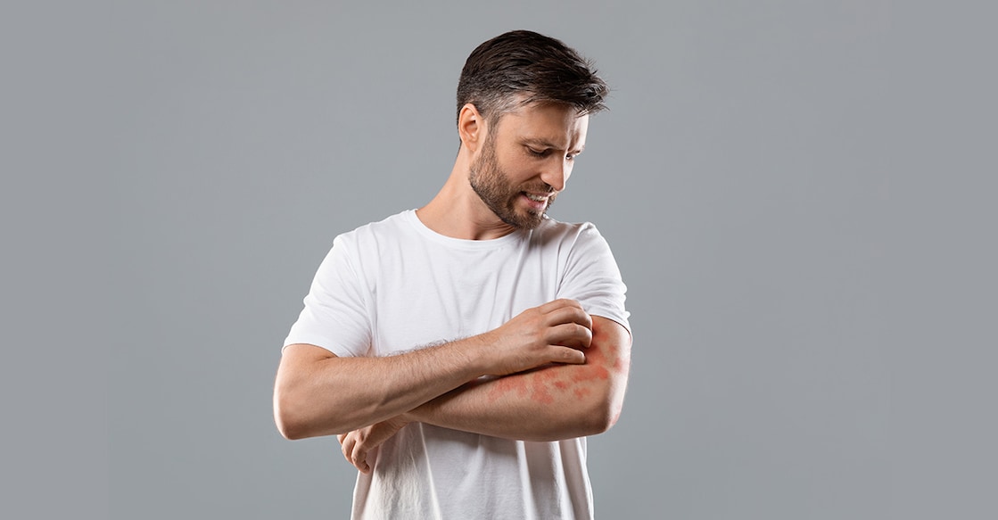 psoriasis-Prostock-Studio-istockphoto Representative image. Photo Credit: Prostock-Studio/istockphoto.com