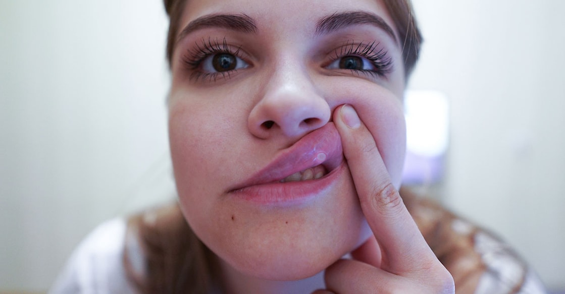 Causes of mouth Ulcers Representative Image. Photo Credit : Jimmy Tudeschi / Shutterstock.com