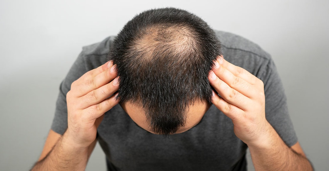 hair-loss-ozanuysal-istockphoto hair-loss-ozanuysal-istockphoto