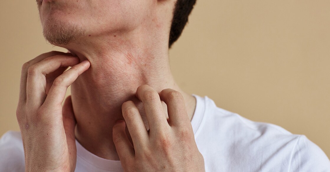 Psoriasis Vulgaris Representative Image. Photo Credit : Seventy Four / iStockPhoto.com