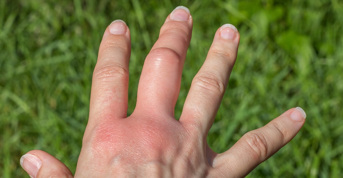 wasp-sting-Inna-Kozhina-istockphoto Representative image. Photo Credit:Inna-Kozhina/istockphoto.com