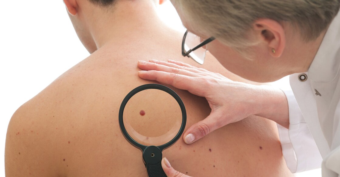 skin-cancer-AlexRaths-istockphoto