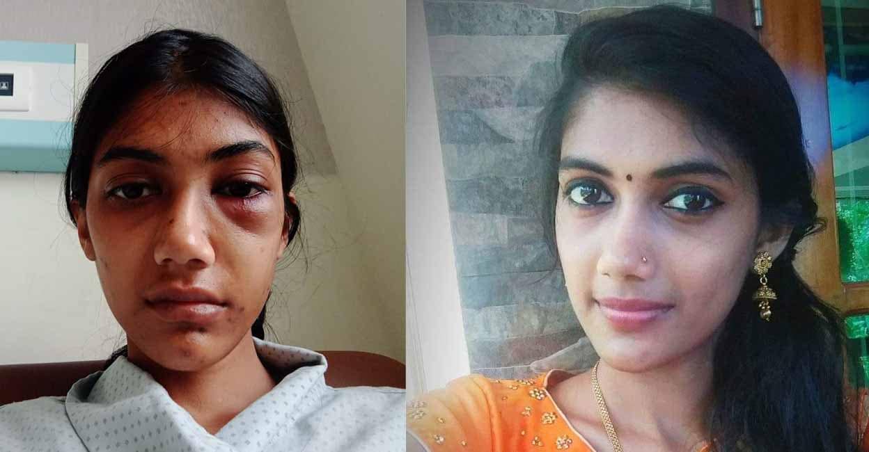 Cruelty of mother-in-law's friend; Woman in critical condition after being hit in the face | Attack Against Women Kerala - Time News Cruelty of mother-in-law's friend; Woman in critical condition after being hit in the face | Attack Against Women Kerala - Time News