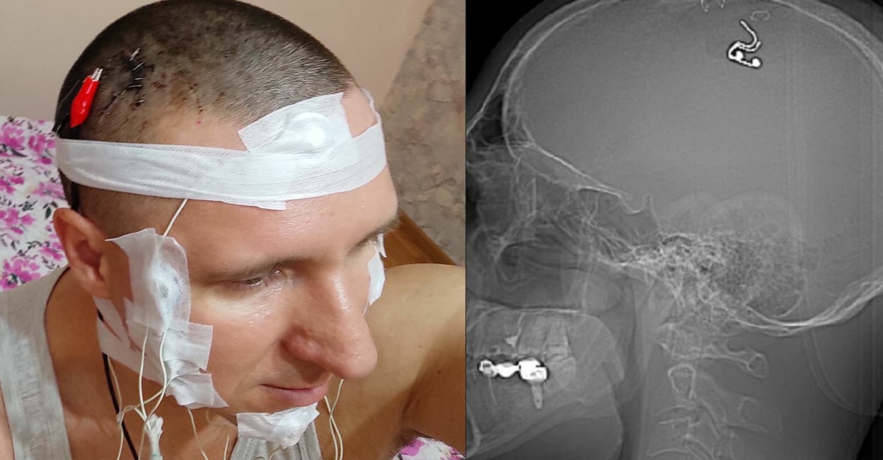 Daring Russian Man Implants Chip in Brain: A Risky Experiment with a Drill