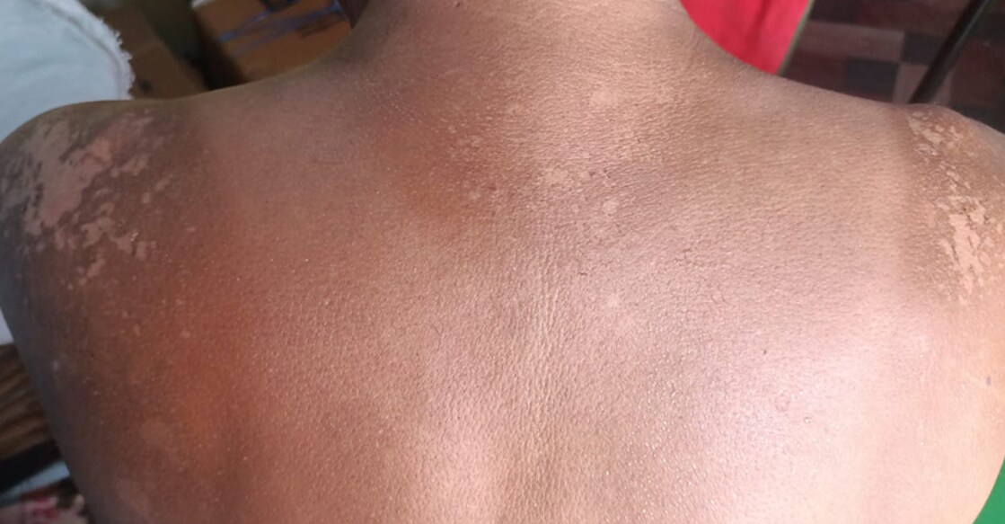 sunburn