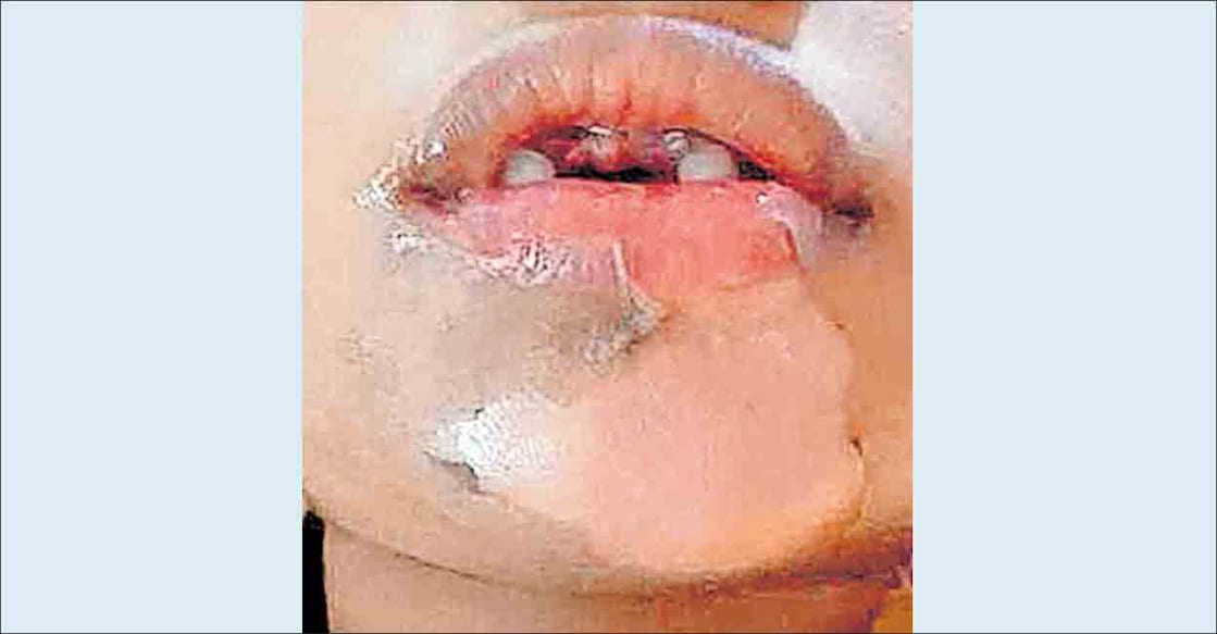 burn-on-face ചൂടുപാൽ വീണ് കുഞ്ഞിന്റെ മുഖം പൊള്ളിയ നിലയിൽ.