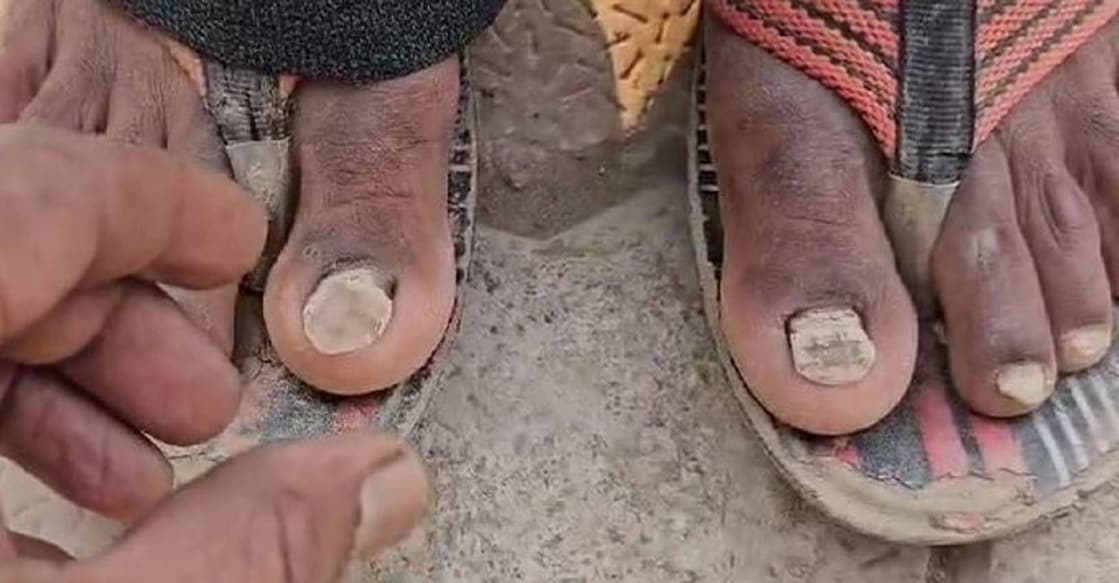 nail-loss-buldhana Photo:X