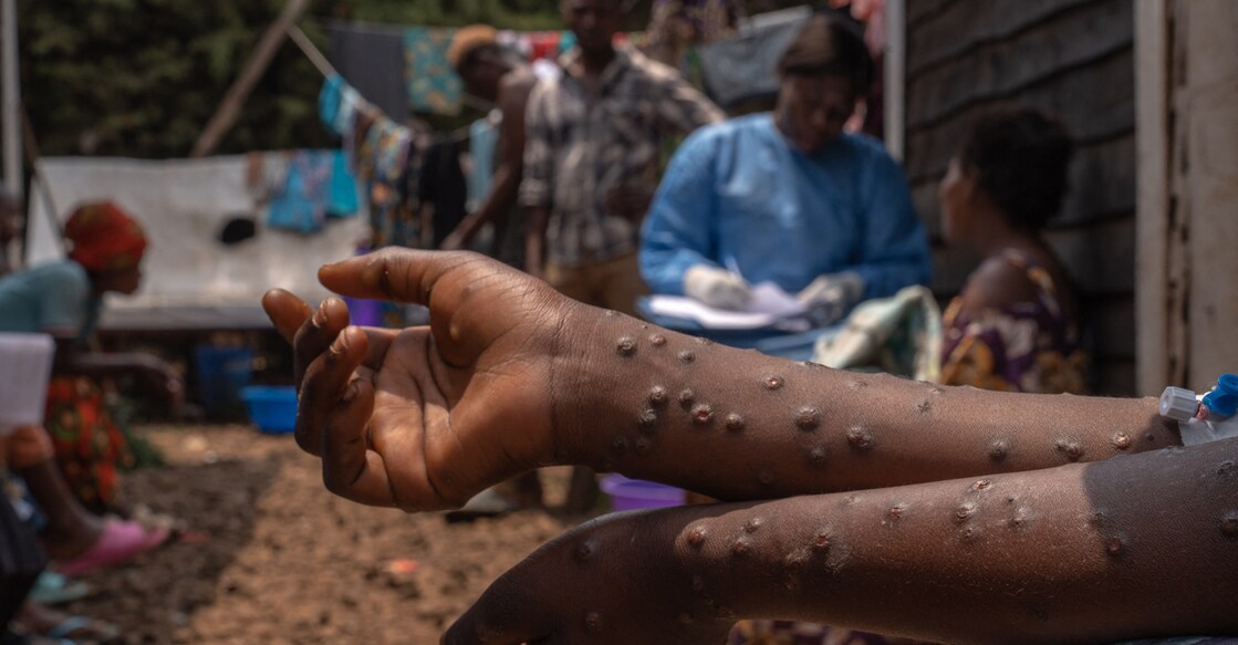 EDITORS NOTE: Graphic content / A patient suffering from mpox sits on a bench at the Kavumu hospital, 30 km north of Bukavu in eastern Democratic Republic of Congo, August 24, 2024. - South Kivu province has recorded more than 5,000 cases of monkey pox since the beginning of the year. The Miti-Murhesa health zone, where the Kavumu hospital is located, has seen over 800 cases, including 8 deaths, all of them children under the age of 5. The Democratic Republic of Congo is the global epicenter of the epidemic, with over 16,000 cases reported, including more than 500 deaths. (Photo by Glody MURHABAZI / AFP)