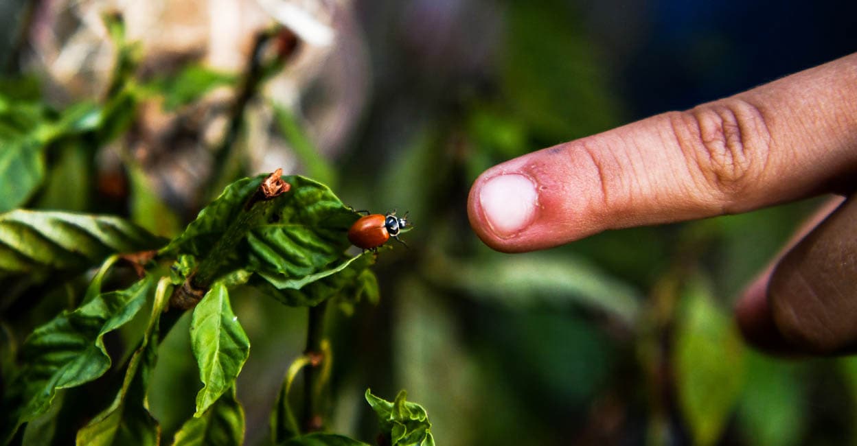 insect-bite-manorama-premium