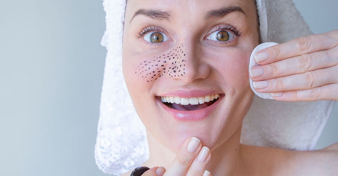 6-safest-and-natural-remdies-to-remove-blackheads Image Credits: Geinz Angelina/Shutterstock.com