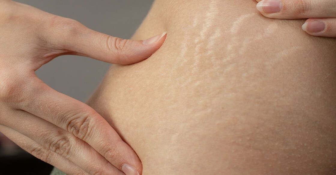 stretch-mark Representative Image: Epov Dmitry/ Shutterstock