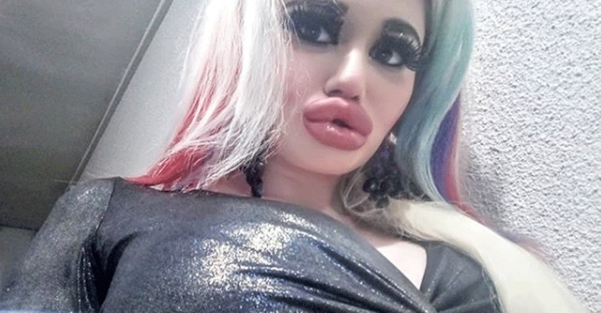 യുവതിക്ക് സംഭവിച്ചത് Biggest Lips Look Like Barbie Doll Acid Injection Manorama News 